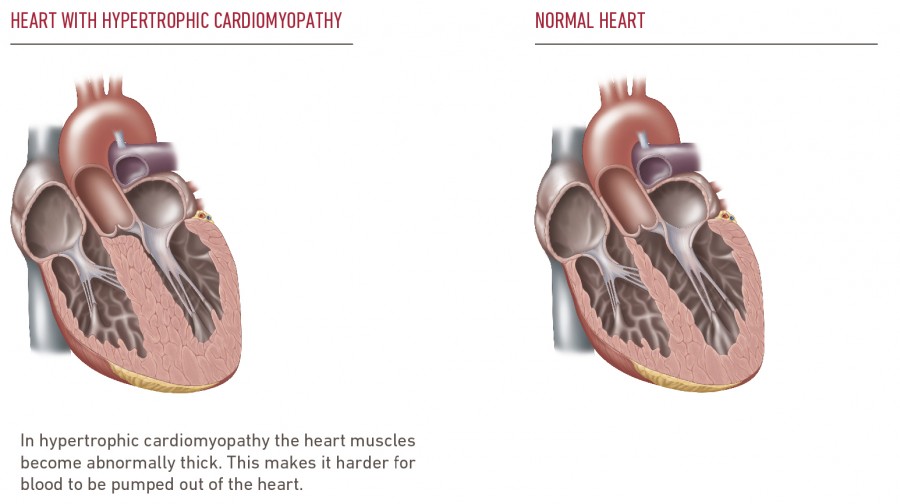 Hypertrophic Cardiomyopathy Temple Health